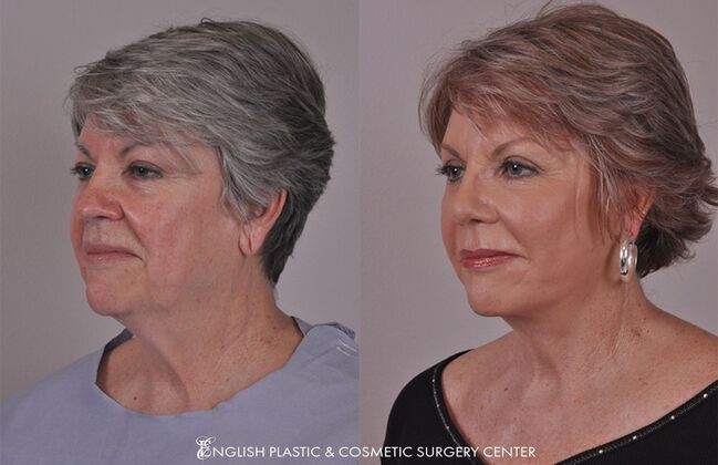 Eyelid Surgery: Case 49 - Before & After