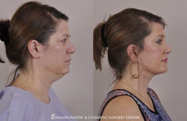 Eyelid Surgery: Case 27 - Before & After
