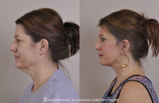 Eyelid Surgery: Case 27 - Before & After