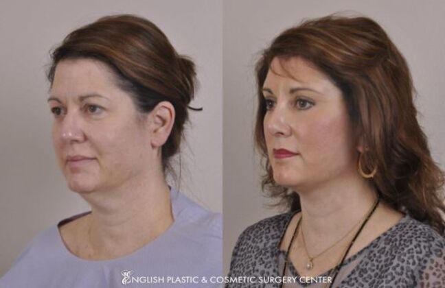 Eyelid Surgery: Case 27 - Before & After