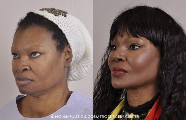 Eyelid Surgery: Case 32 - Before & After