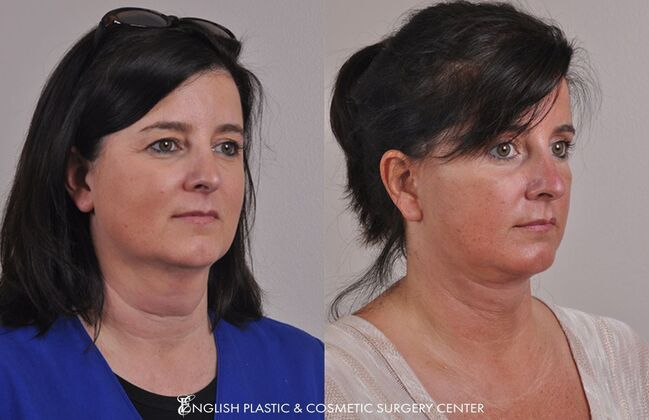 Eyelid Surgery: Case 38 - Before & After
