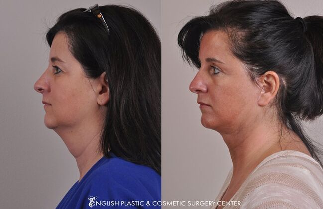 Eyelid Surgery: Case 38 - Before & After