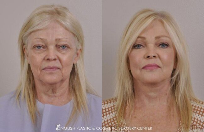 Eyelid Surgery: Case 41 - Before & After