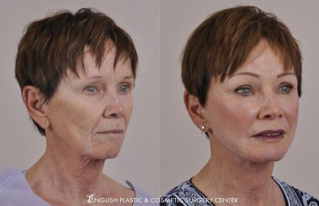 Eyelid Surgery: Case 42 - Before & After