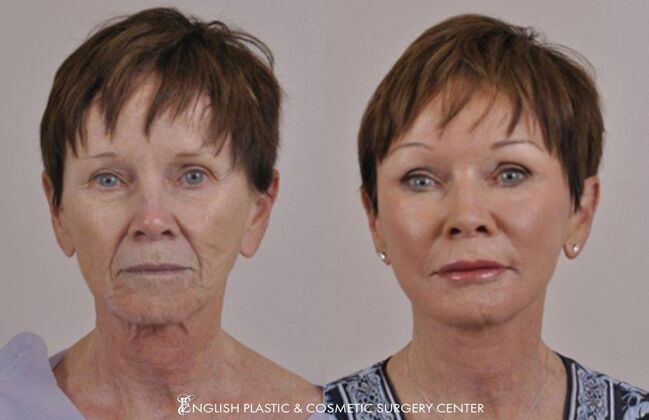 Eyelid Surgery: Case 42 - Before & After