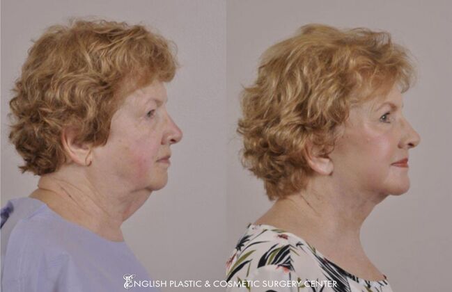 Eyelid Surgery: Case 43 - Before & After