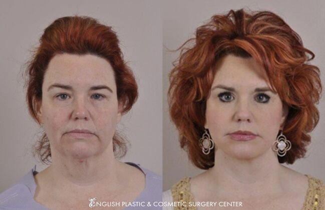 Eyelid Surgery: Case 45 - Before & After