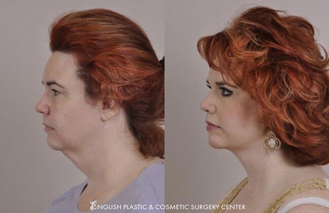 Eyelid Surgery: Case 45 - Before & After