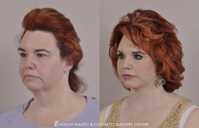 Eyelid Surgery: Case 45 - Before & After