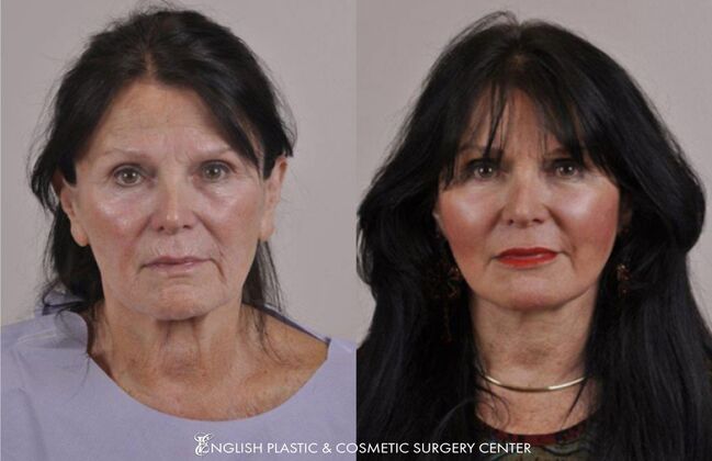 Eyelid Surgery: Case 47 - Before & After