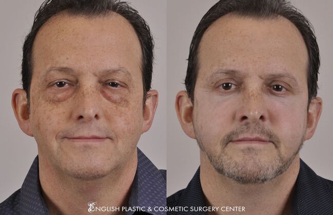 Eyelid Surgery: Case 19 - Before & After