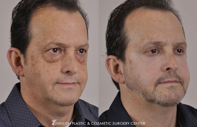 Eyelid Surgery: Case 19 - Before & After