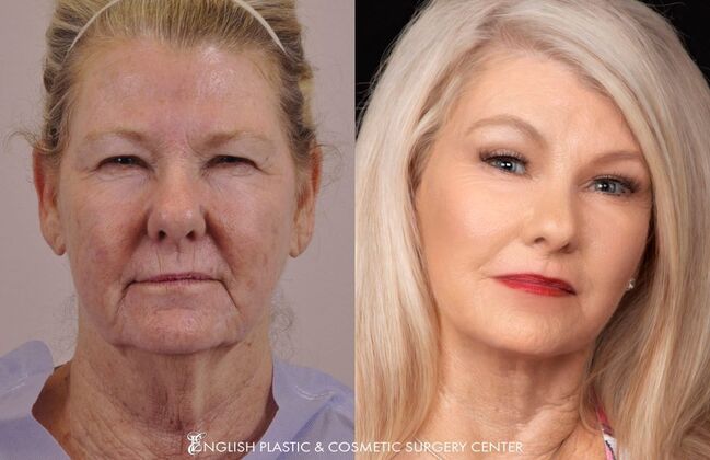 Eyelid Surgery: Case 10 - Before & After