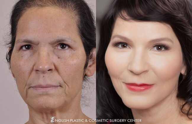 Eyelid Surgery: Case 8 - Before & After