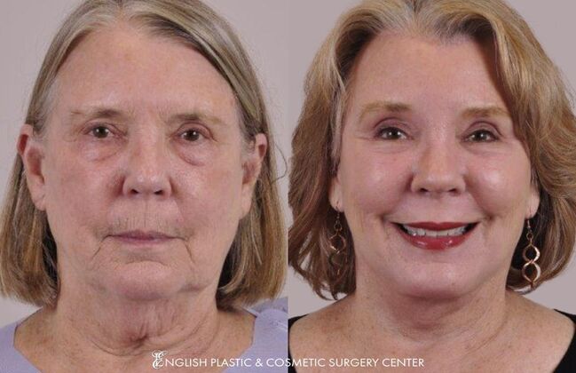 Eyelid Surgery: Case 7 - Before & After