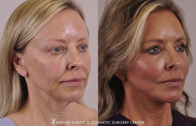 Eyelid Surgery: Case 9 - Before & After