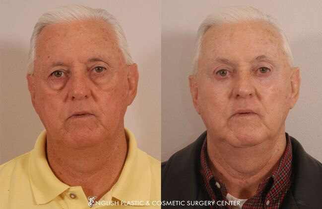 Brow Lift: Case 30 - Before & After