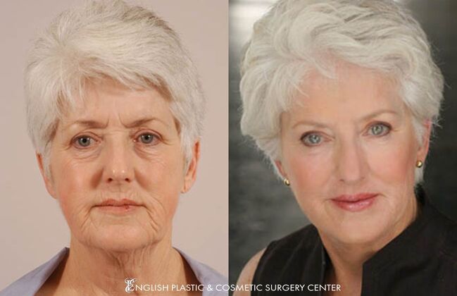 Brow Lift: Case 12 - Before & After