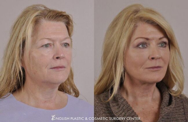 Brow Lift: Case 11 - Before & After