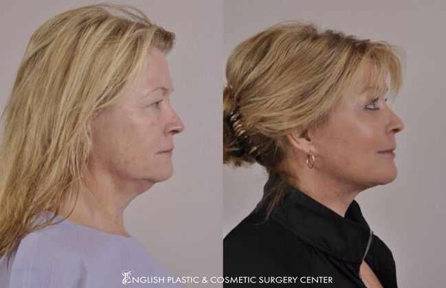 Brow Lift: Case 11 - Before & After