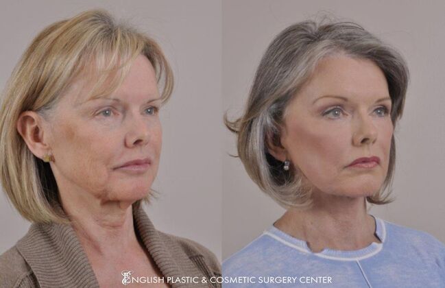 Brow Lift: Case 13 - Before & After