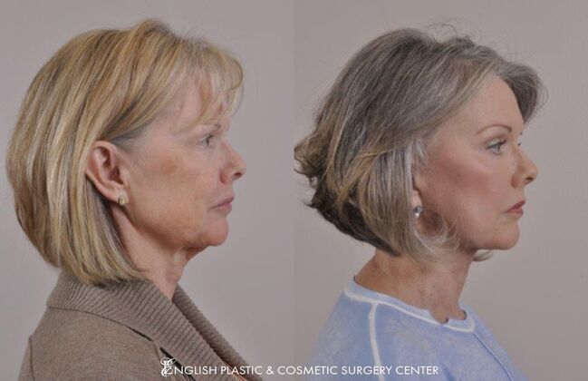 Brow Lift: Case 13 - Before & After