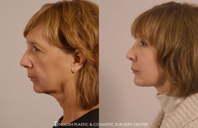 Brow Lift: Case 24 - Before & After