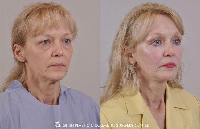 Brow Lift: Case 27 - Before & After