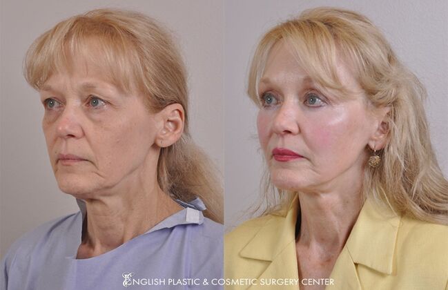 Brow Lift: Case 27 - Before & After