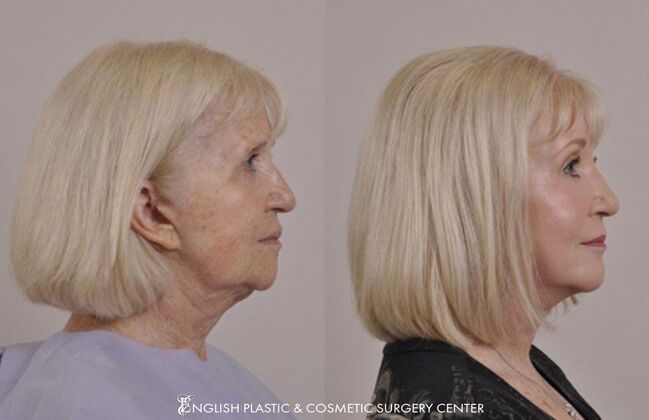 Brow Lift: Case 32 - Before & After