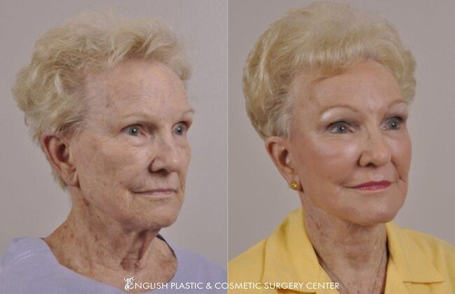 Brow Lift: Case 33 - Before & After