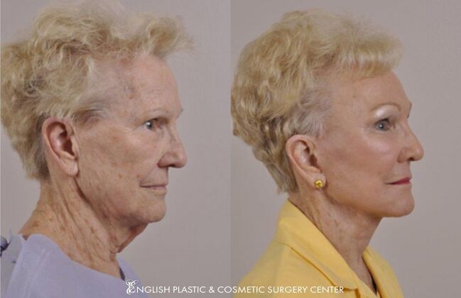 Brow Lift: Case 33 - Before & After