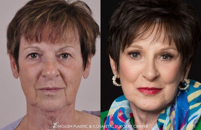 Brow Lift: Case 34 - Before & After