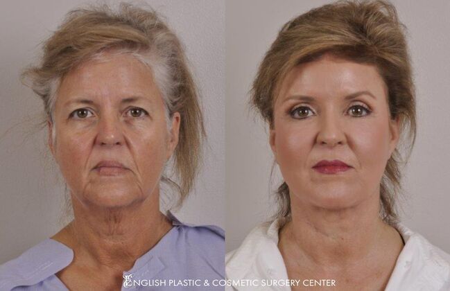 Facelift: Case 33 - Before & After