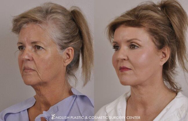Facelift: Case 33 - Before & After
