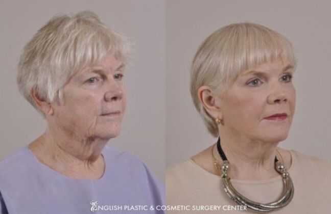 Facelift: Case 25 - Before & After