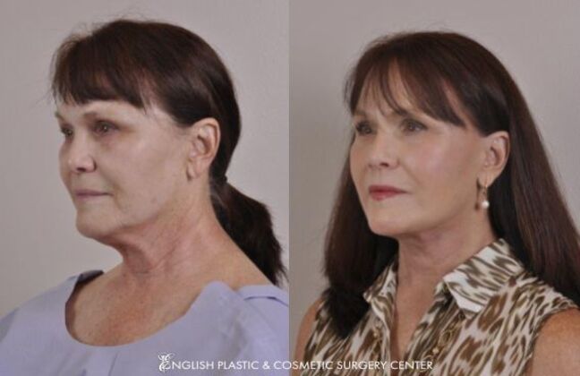 Facelift: Case 23 - Before & After
