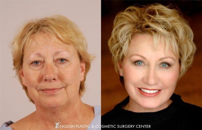 Facelift: Case 18 - Before & After