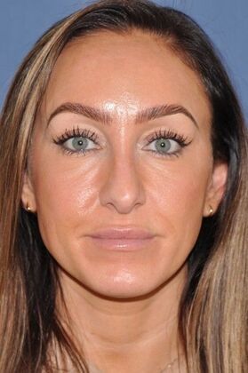 Rhinoplasty: Septorhinoplasty for bent septum, and tip pulling down on smiling. Fantastic! - Before