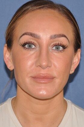Rhinoplasty: Septorhinoplasty for bent septum, and tip pulling down on smiling. Fantastic! - After