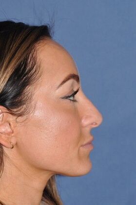 Rhinoplasty: Septorhinoplasty for bent septum, and tip pulling down on smiling. Fantastic! - Before
