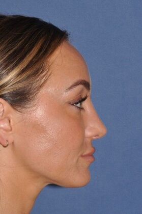 Rhinoplasty: Septorhinoplasty for bent septum, and tip pulling down on smiling. Fantastic! - After