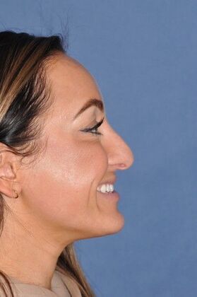 Rhinoplasty: Septorhinoplasty for bent septum, and tip pulling down on smiling. Fantastic! - Before