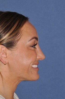 Rhinoplasty: Septorhinoplasty for bent septum, and tip pulling down on smiling. Fantastic! - After