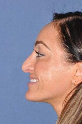 Rhinoplasty: Septorhinoplasty for bent septum, and tip pulling down on smiling. Fantastic! - Before