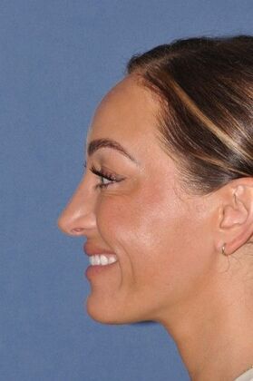 Rhinoplasty: Septorhinoplasty for bent septum, and tip pulling down on smiling. Fantastic! - After