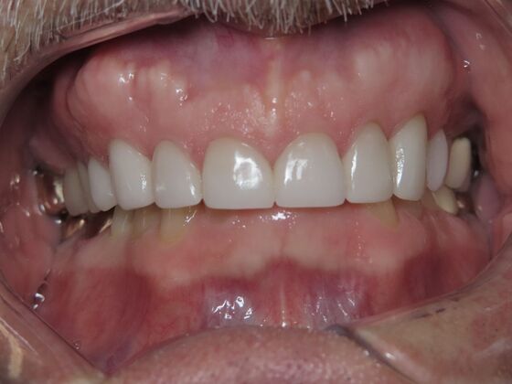 Veneers Case 3 - After