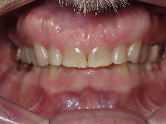 Veneers Case 3 - Before