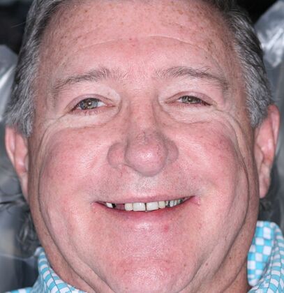 Dental Implants Jeff - Before